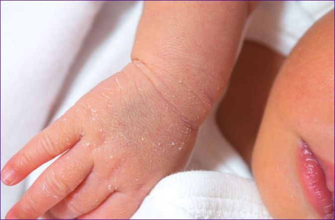 Суха кожа при деца: 20 причини и 10 средства за защита