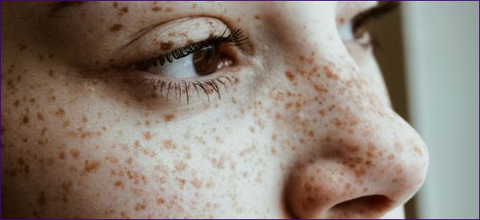 Лунички по лицето: причините, 13 начина за премахване на пигментацията